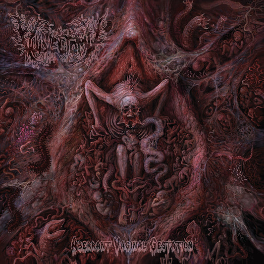 Vulvectomy - Aberrant Vaginal Gestation [CD] [New CD]